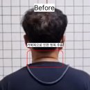 신중동PT 명품피티 | 신중동재활PT 거북목 방치하면 버섯목 됩니다