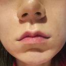 [후기/뷰티] 대구쥬베룩볼륨 시술후기 (콜라겐부스터 내돈내산)