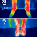 다리 통증 무릎 통증에 관리 받기 좋은 곳 - 풋43 명륜소호점