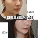 첼로병원 | 잠실피부과 피아모리프팅 안아픈 고주파리프팅 통증 멍 전후 후기