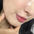 명동 피부과 포텐자 솔직 후기! 모공관리 효과는?