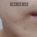 플러스에이앤씨 | [홍대여드름관리] 에이앤씨스페이스 홍대피부관리실 방문후기 (여드름관리 피부관리 1:1피부관리)
