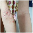 지엘XIEL | 지엘화장품 아토피 후기 간지러울때마다 지엘화장품