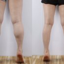 하이엔드성형외과의원 | 214.종아리 지방흡입수술 효과와 LEGISH의 만남: 쫑알주사로 완성하는 갓생 다리근육 라인 - 후기,관리