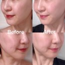 일산 킨텍스역피부과 올리디아 콜라겐부스터 팔자개선 후기