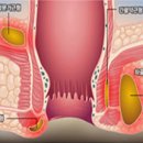 치루[anal fistula] 이미지