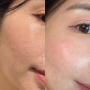 부산 리쥬란 손주사 양산 피부과 솔직 후기 (엠보, 통증, 효과)