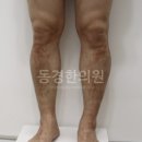 경화반점 네이버블로그