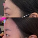 디자인해드림 | 대구이마필러 중구동성로피부과 시술전후차이 효과 추천 후기