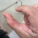 반창고 | 밴드 알러지 접착제 알러지 | 상처보다 더 아프고 가려운 반창고 알레르기 극복 후기
