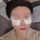 2 | 대구동성로피부과 리쥬란아이 2cc 솔직 후기