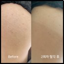 아무리 돈 써도 안 없어지던 오래된 흰 튼살없애는법, 어바웃스카 엉덩이 튼살커버