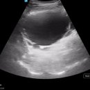 Urinary bladder diverticulum 방광게실 이미지