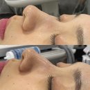 써니 뷰티 | 신중동 블랙헤드 파괴! 에어플라즈마 관리 써니뷰티 후기