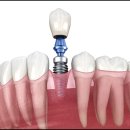 리더스온 치과기공소 이미지