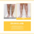 갑자기 생긴 빨간 반점, 알레르기성 자반증?