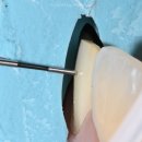 김준엽치과의원 | 압구정치과 마음에 안 드는 앞니 크라운 핵심은 실활치미백