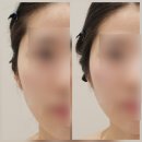 안산점 현대자동차 | 효과 직방 이혈 테라피 안산 웨딩 윤곽관리 에스테틱샵ㅣ 안산 온기 에스테틱