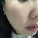 라움성형외과의원 | 압구정 라움성형외과 흑자 주근깨 흑자제거 1년후 현재상태 솔직후기 그리고 2차예약