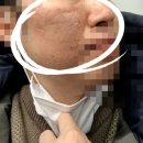 오가나셀피부과의원 | 피부 리셋이 필요할 때, 청담 오가나셀 울트라 클리어 시술 후기