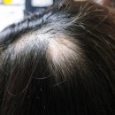 영등포 계피부과 | 여성 원형탈모 주사 치료 2개월 차 리얼 후기 내돈내산 진행중