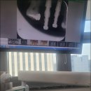 연세좋은치과기공소 | 임플란트 본뜨기 얼마나 불편할까?｜중구 연세 네이쳐 치과 솔직 후기