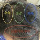 공지로3 | [공지] 피나스테리드 3개월 후기, 머리 변화 솔직 정리