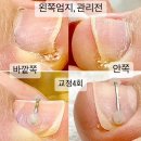 👣의정부 민락동 엄지발톱 염증 붓기 통증 ㅣ 은영 부원장 내성발톱 케어 후기
