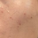 가음정약국 | 창원 녹십자의원 - 점 뺀 후기, 방문시간, 소요시간 꿀팁