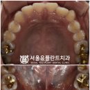 장안동 치과 신경과 가까운 고난도 매복 사랑니 발치 후기