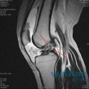 * 십자인대파열 * 십자인대파열 증상과 수술 [ 관절내시경 ] 이미지