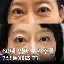 60 | 강남역튠아이즈 눈가리프팅 후기 60대 엄마 눈가주름 관리