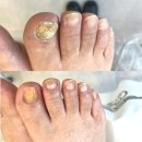장산 | 무좀 문제성발톱관리 닥터페디해운대장산점 방문후기