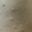 김정민내과의원 | 대상포진으로 시작하는 추석 연휴, 10월 첫째 주