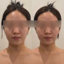 제이윤 에스테틱 | [제목] 마곡안면비대칭, 턱관절부터 바로잡는 제이윤 에스테틱 두골비 솔직후기