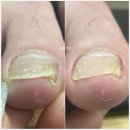 풀리메디시흥월곶점네일박스 | 시흥 월곶 내성발톱 무좀발톱 발톱무좀 발각질 전문관리샵 추천 네일박스