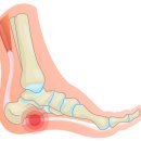 여름철 잘 신고 다닌 샌들, 슬리퍼 혹시 발바닥 찌릿찌릿하시지는 않나요? 이미지