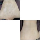 산호한의원 | 평택 여드름 등드름 없애는 방법 알려드릴게요 :)