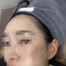 덕천약국 | 덕천 피부과 내돈내산 점제거후기 / 통증 , 색소침착 일주일 후기