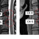 타임스님의 경추, 요추 디스크 MRI 판독입니다. 이미지