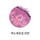 색소 세포성 모반ㅔMelanocytic nevus] 피부질환 이미지