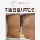 수원-1861 | 복부 바본관리 지방흡입 사후관리 효과, 실제 변화 후기