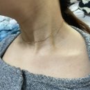 [신촌 한의원] 목&amp;쇄골 편평사마귀 제거 후기