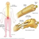 다발성경화증multiple sclerosis 이미지