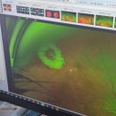 신안과의원 | 망막열공 후기 | 증상 없이 발견 후 당일 광응고술 받은 이야기 (비용·통증·과정 정리)