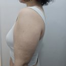 팔 지방흡입 고민하다가 선택한 라인업관리! 파주 운정 야당 제트슬림 고객후기