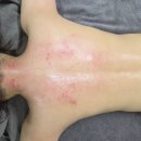 영바디 | 천안 산후관리 어디갈지 고민이면, 영바디케어 붓기관리 후기 (진짜 달라짐)