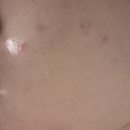 아토리서치노동조합 | 투앤티크림 실사용 후기 - 1주차 부작용 : 뒤집어짐 ..초반 방심하면 진짜 큰일납니다