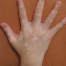 백반증 원인 및 치료 (얼굴, 피부 등) 이미지