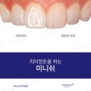 S.M.치과기공소 | 부산미니쉬 수영하임치과에서 만나는 미니쉬, 부산에서도 가능한 치아복구의 혁신